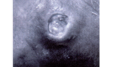 piede-diabetico-3