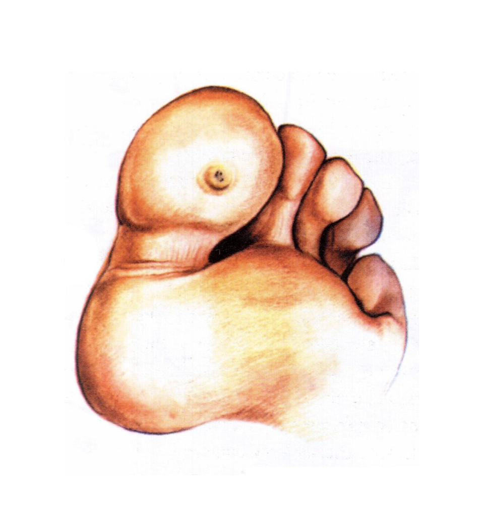 verruca
